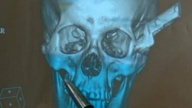 Brazilian man rides motorcycle 60 miles to hospital with knife in his head
